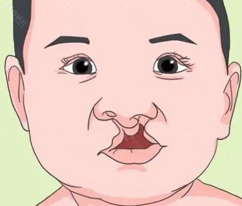 毛喆医生唇裂技术好还是李精韬好？