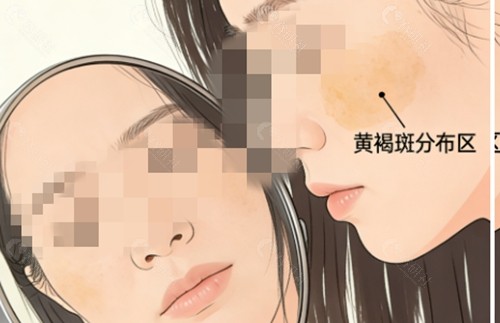 西安米兰柏羽医疗美容医院治疗黄褐斑好吗