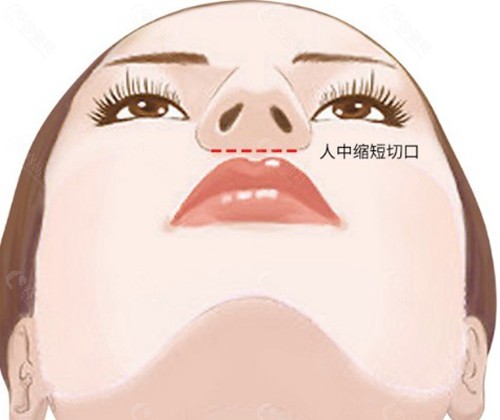 为什么术后30天会变硬？揭秘“增生期”