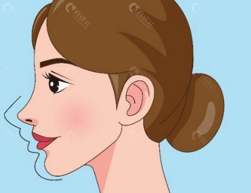 为什么选择PEEK材料进行下颌角修复？