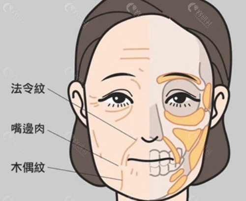 袁强博士：MCR复合提升，主打“解剖复位”与“自然度”