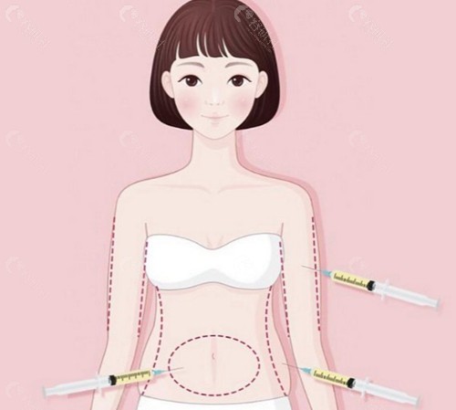 水动力吸脂：高压水流的“分离术”