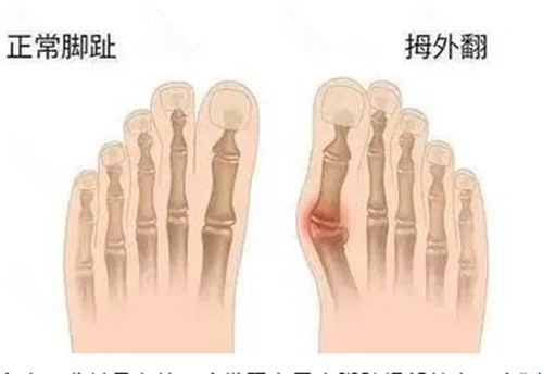 国内拇外翻手术医生