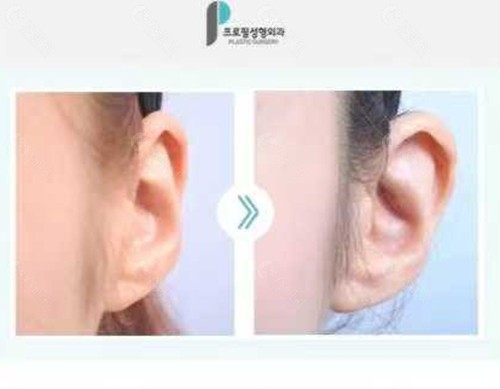 韩国普罗菲耳精灵耳打造好吗