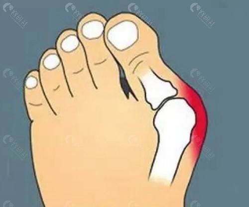 耿興田大腳骨手術的核心技術：微創大腳骨矯正術