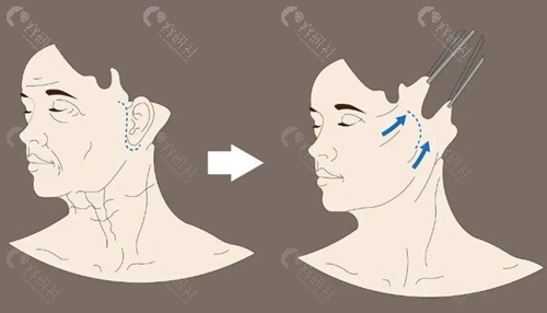 北京拉皮手術口碑醫生及技術特色解析