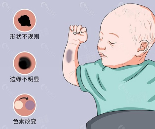 激光还是手术？先看你的胎记是“哪路人”