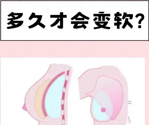 魔滴Motiva假体术后多久变柔软？
