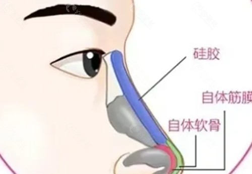株洲焕妍医疗美容隆鼻好吗