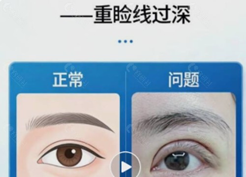 双眼皮做的太深了还能修复好吗