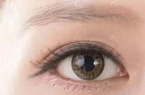 双眼皮做窄了还能修复好吗