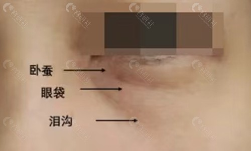 珠海如花医疗美容去眼袋怎么样