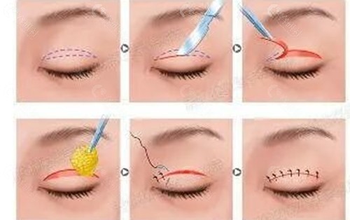 温州维多利亚医疗美容医院眼综合怎么样