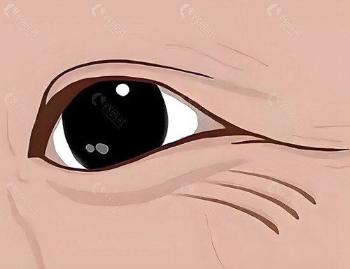 嗨体去眼纹和除皱针哪个好