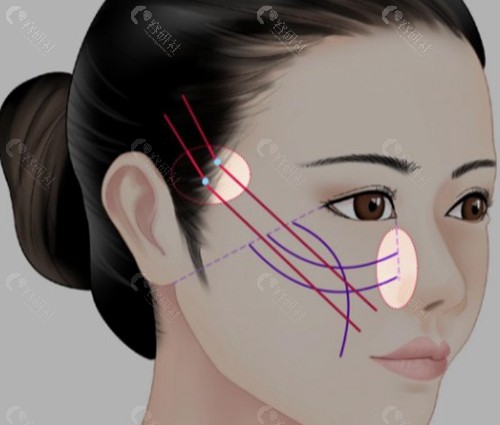 “一针降颧骨”：是打针还是手术？