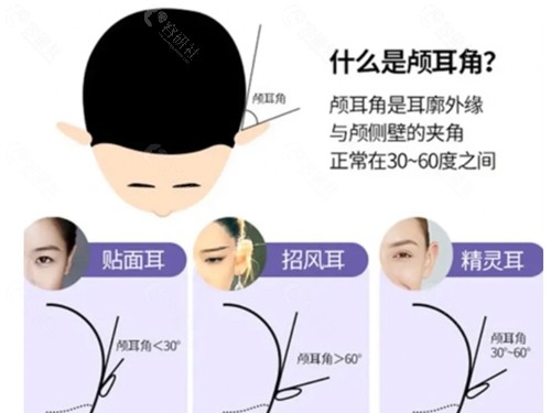 精灵耳需要几支玻尿酸