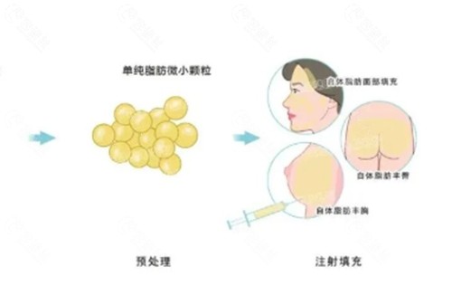 乔长顺脂肪填充好吗