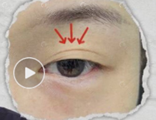 埋线双眼皮松脱了还能修复吗？