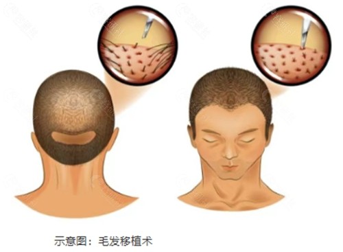 南通大麦微针植发好吗