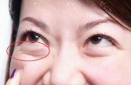 李鹏（深圳阳光整形）去眼袋好吗