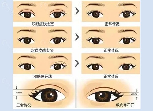 胡劲松眼修复好吗