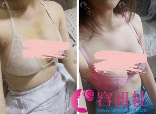 韩国普罗菲耳整形医院假体隆胸术前术后对比照