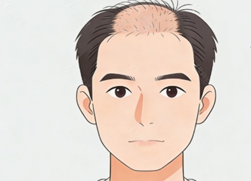 大同京城医疗美容治疗脱发好吗