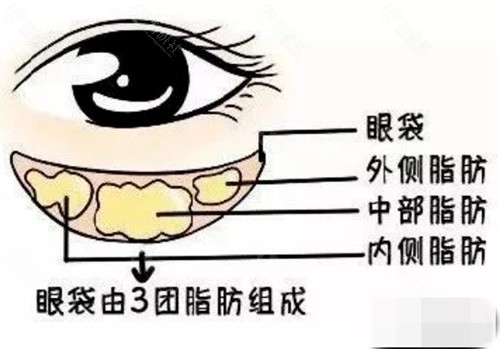 脂肪膨出型眼袋怎么消除？