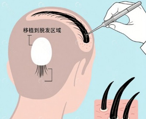 胡志奇植发到底怎么样？