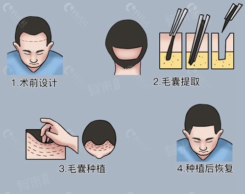 他适合什么样的脱发患者？