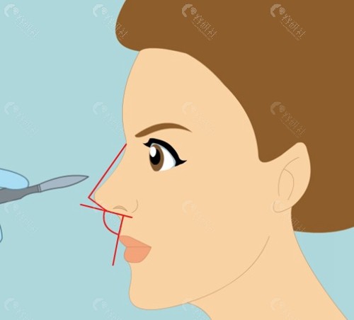 韩国鼻综合一般价格多少钱？