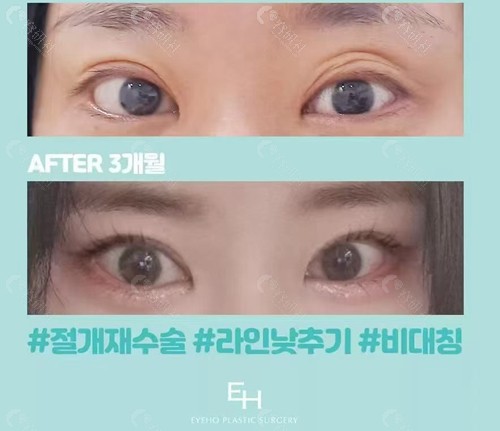 韩国EH眼修复好吗