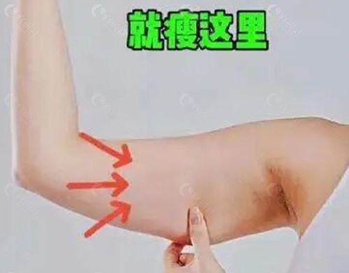 手臂打溶脂针效果好吗？