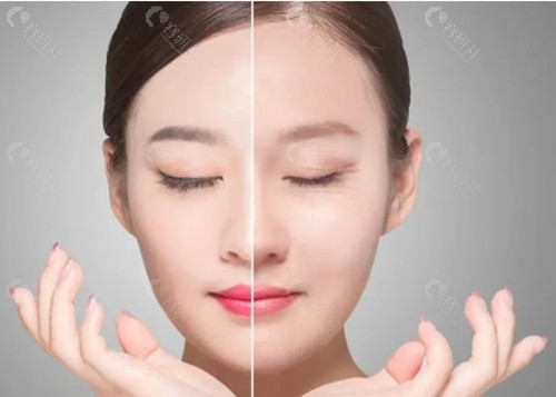 韩国GIO整形外科做眼修复怎么样