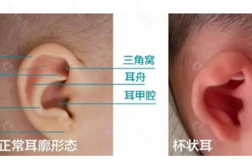 杯状耳手术费大概多少？