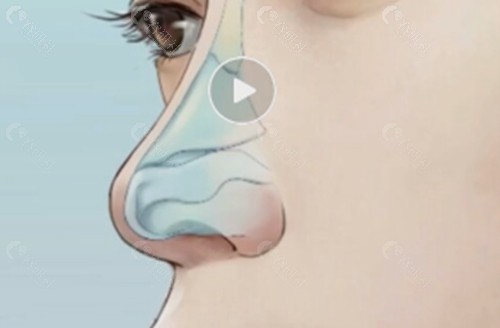 清远粤时光医疗美容隆鼻好吗