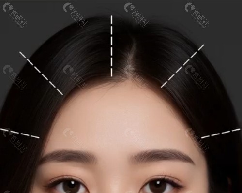 韩国Yourtime额头提升整形外科额头提升好吗