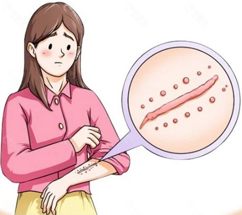 昆明做疤痕修复大概需要多少钱？