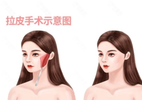 魏广运 拉皮手术好吗