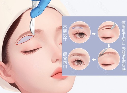 术后1-7天，你的面部组织在经历什么？