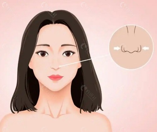 韩国做鼻翼缩小哪家好? 韩国做鼻翼缩小哪家好?