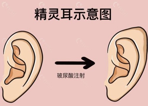 韩国做精灵耳注射哪家好?六大名院核心优势大比拼 韩国做精灵耳注射哪家好?六大名院核心优势大比拼