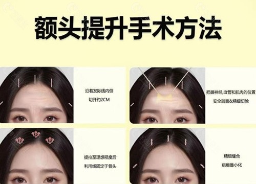 2026年额头提升手术价格