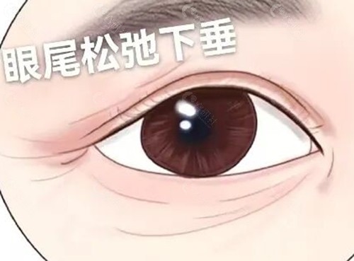 眼尾下垂有什么办法提升？