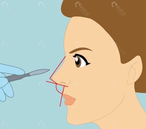 韩国隆鼻到底用硅胶还是膨体? 韩国隆鼻到底用硅胶还是膨体?