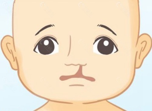 赵久丽医生做唇裂修复怎么样?核心技术优势解析 赵久丽医生做唇裂修复怎么样?核心技术优势解析