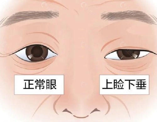 眼睑下垂矫正为什么容易面临多次手术？