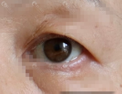 50岁做双眼皮会年轻吗？