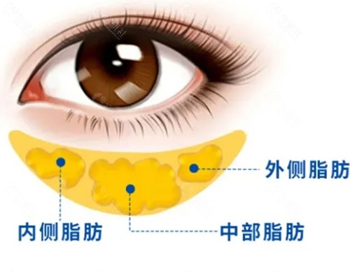 王懿去眼袋好吗