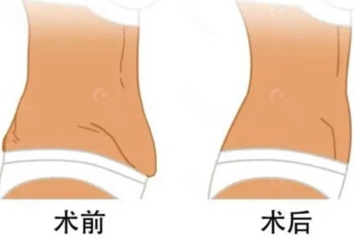  王进刚医生腹壁成形术核心技术特色与解剖学优势